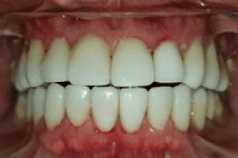 Patient smiling after dental crowns