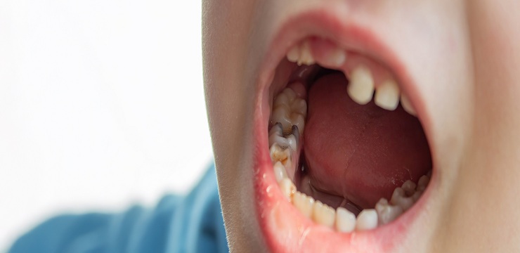 Dental healthcare - baby teeth with caries.